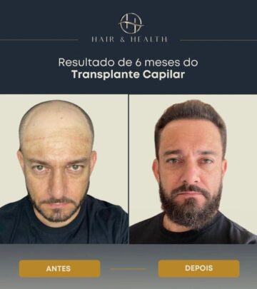 Transplante Capilar Região Extensade R$ 25.000,00 por R$ 19.990,00