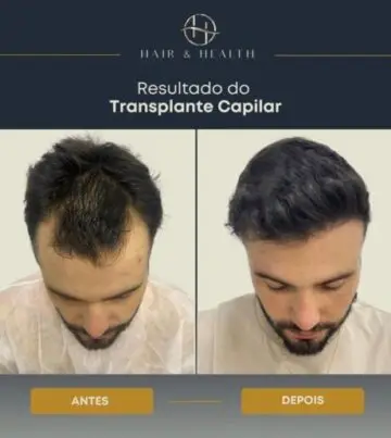 Transplante Capilar nas Entradasde R$ 22.000,00 por R$ 16.990,00