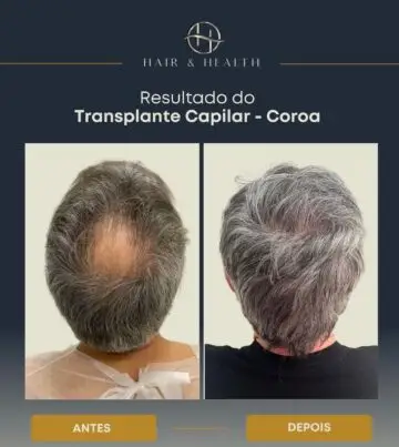 Transplante Capilar na Coroade R$ 22.000,00 por R$ 16.990,00